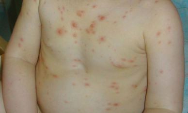 Hlaupabóluútbrot á barni